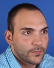 Before Hair Transplant&nbsp;Front